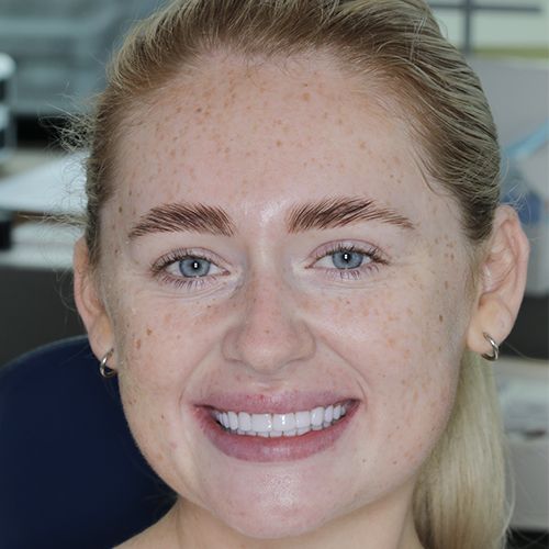 composite bonding-after - Carly - 3dental